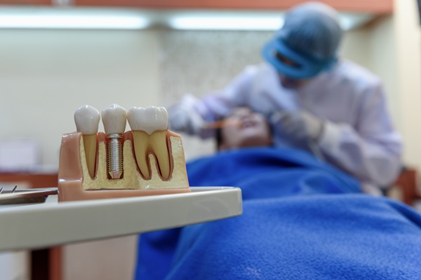 Why Dental Implants Are Comfortable And Secure